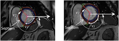 Analysis of Cardiac Amyloidosis Progression Using Model-Based Markers